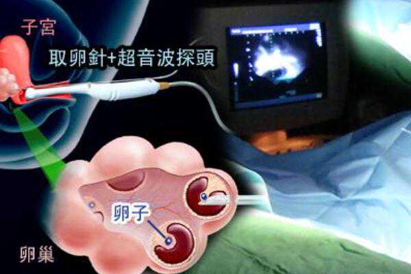广州金贝供卵医院官网,广州做供卵试管-专业代孕双胞胎